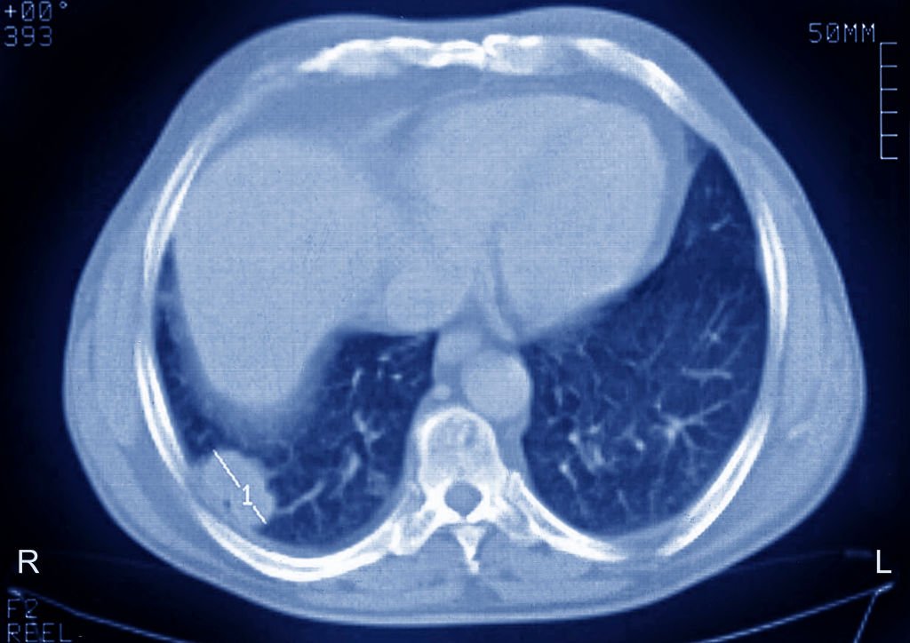 Pulmonary Metastases Secondary Cancer, Carcinoma. Thoracic Scan In Axial Section. (Photo By BSIP/UIG Via Getty Images)
