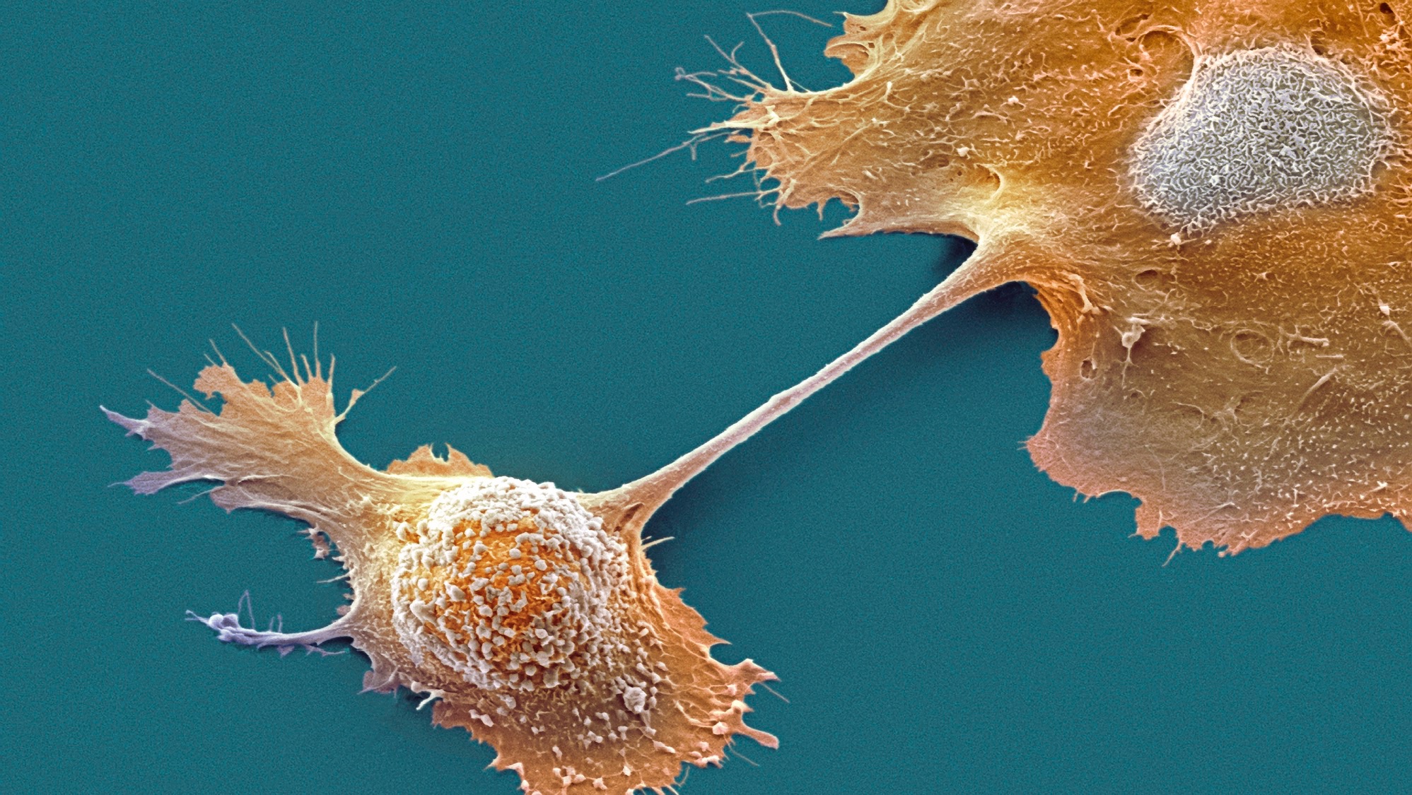 Pancreatic cancer cells. Coloured scanning electron micrograph (SEM) of pancreatic cancer cells. The cells are joined by a cytoplasmic bridge. The irregular shape of the cells, the cellular projections and blebs (nodules) are typical of cancer cells. Pancreatic cancer often causes no symptoms until it is well established and untreatable.