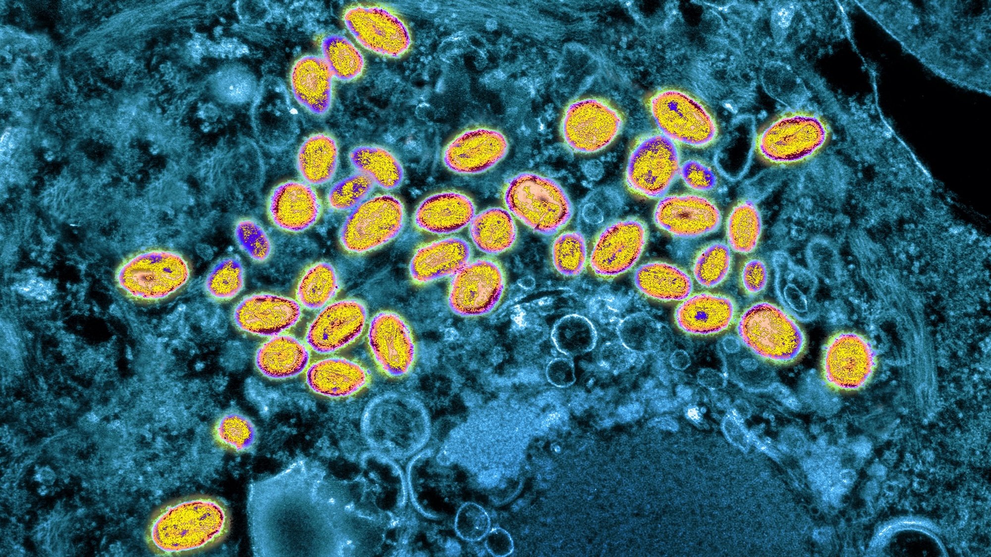 Smallpox virus seen under microscope