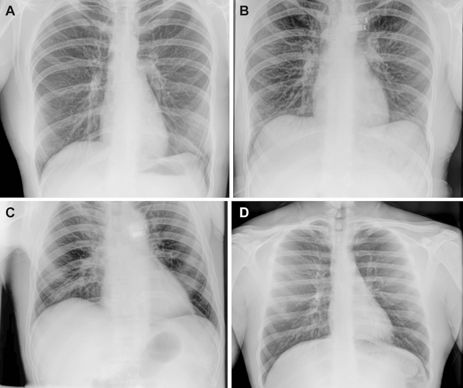 Representative preflight, in-flight, and postflight chest radiographs. Radiographs of the chest were acquired (A) preflight by a crewmember, (B, C) in-flight on day 3 after launch (L+3) by a crewmember, and (D) postflight by a non-crew operator using the same imaging protocol. Credit: Radiological Society of North America (RSNA)