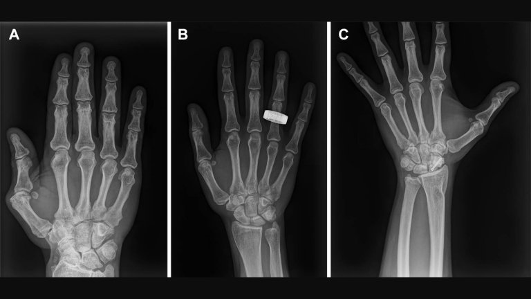 Representative preflight, in-flight, and postflight hand radiographs. Radiographs of the hand were acquired (A) preflight by a crewmember, (B) in-flight on day 1 after launch (L+1) by a crewmember, and (C) postflight by a non-crew operator using the same imaging protocol. Credit: Radiological Society of North America (RSNA)