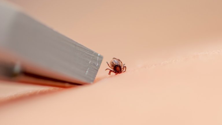 The tick is removed with tweezers from the baby's skin.