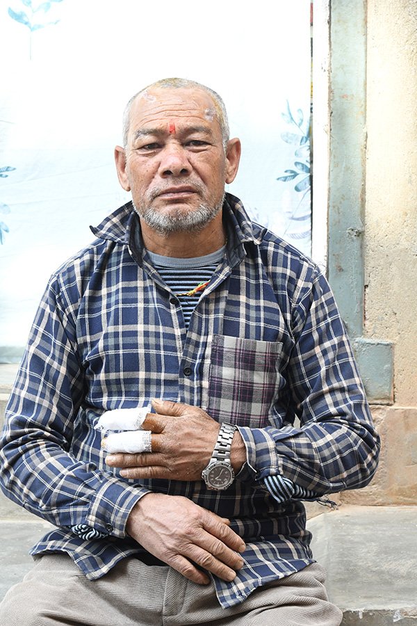 Photo of a sitting man in a plaid shirt with bandages on his fingers.