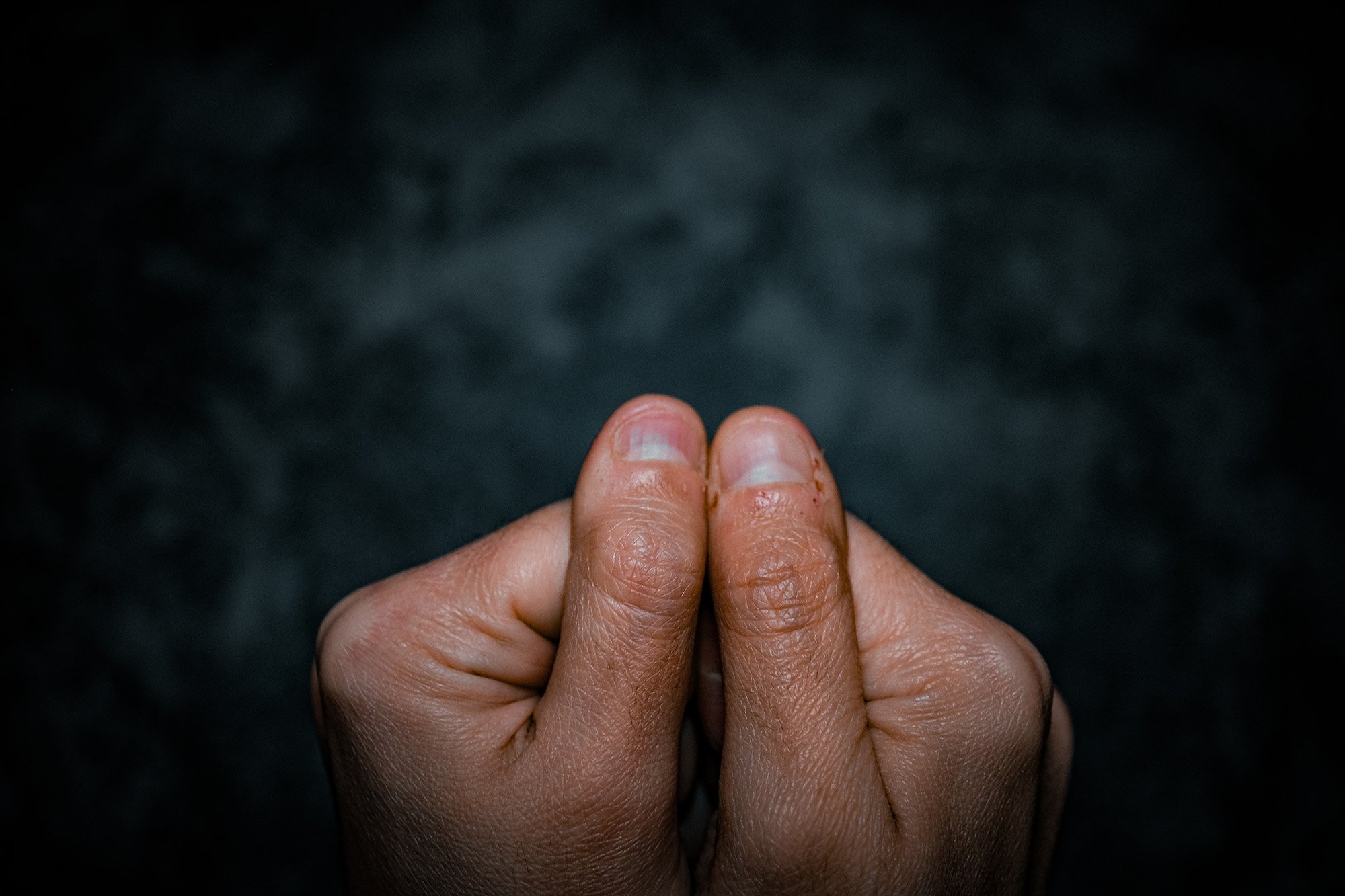 Damaged nails and cuticles shown against a dark background