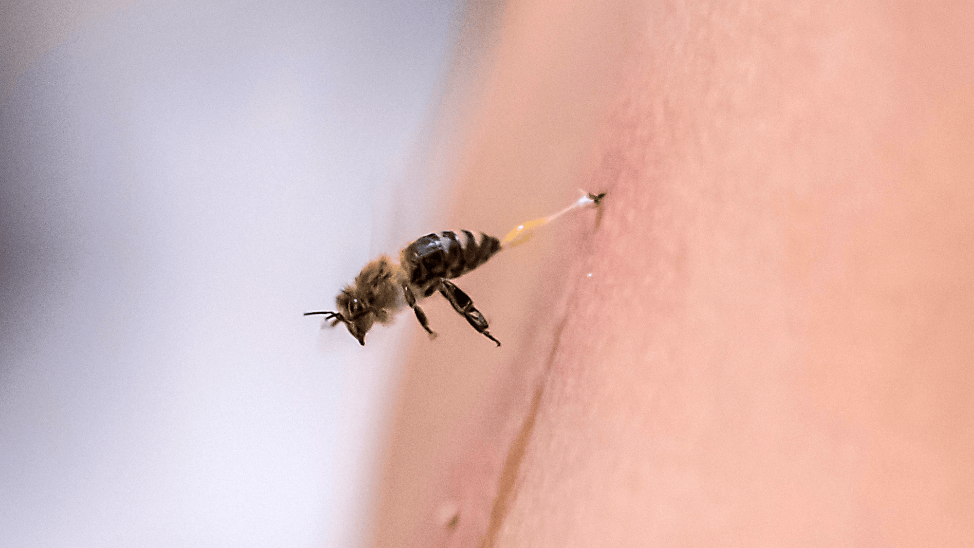 a bee stinging human skin
